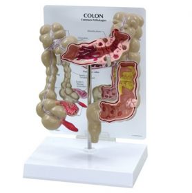 Colon Model with Common Pathologies [Pack of 1]