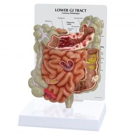 Lower GI Tract with Pathologies Model [Pack of 1]
