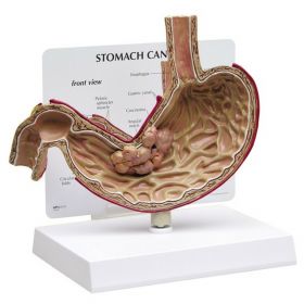 Stomach Cancer Model [Pack of 1]