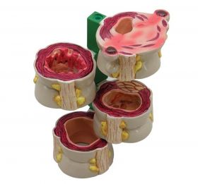 Colon Model with Pathologies (4 piece) [Pack of 1]