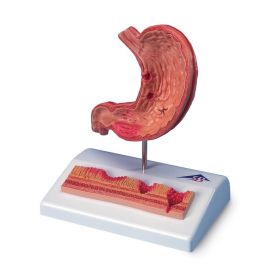 Stomach Model With Ulcers [Pack of 1]